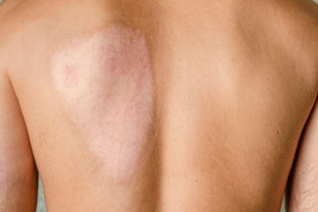 treatment-skin-grafting